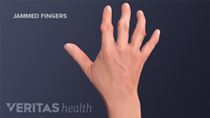 Dorsal view of jammed fingers