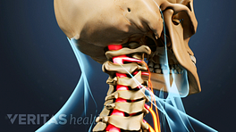 Profile view of neck twisting to show cervical radiculopathy.
