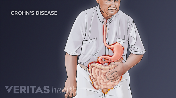 An illustration showing a person with gastrointestinal problem.