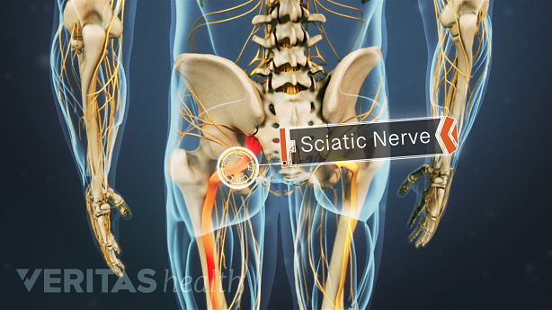 melodisk synd koks Types of Sciatic Nerve Pain | Spine-health