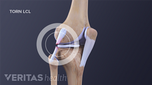 Profile views of the knee joint showing a torn LCL