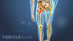 Ilustración médica de un esqueleto. El nervio ciático, a lo largo de la pierna, está resaltado en rojo.