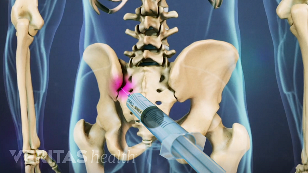 Illustration showing pelvis with SI joint highlighted in pink and a needle inserted into the joint.