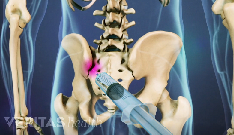 Illustration showing pelvis with SI joint highlighted in pink and a needle inserted into the joint.