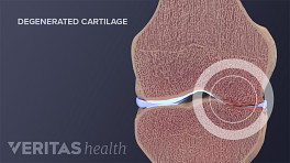 Cross section of the knee showing degenerated cartilage