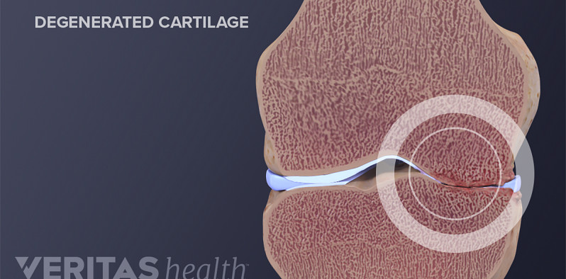 Cross section of the knee showing degenerated cartilage