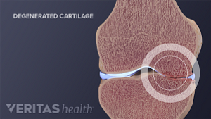 Medical illustration of degenerated knee cartilage