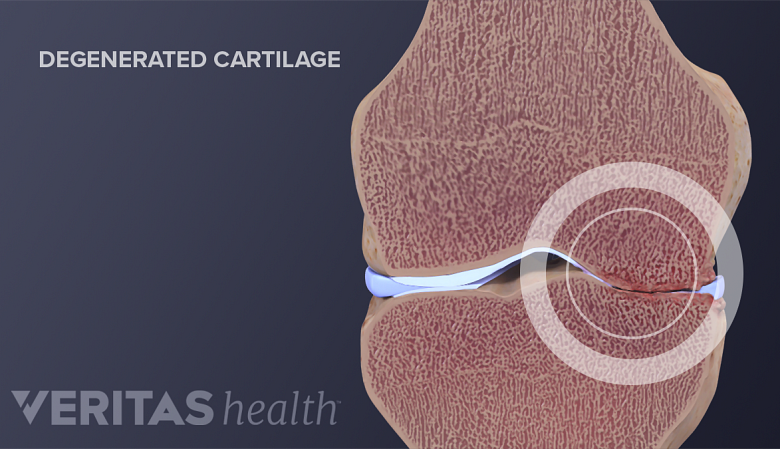 Degenerated cartilage in the knee joint