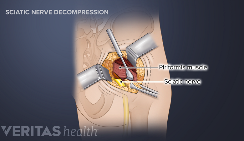 Una ilustración que muestra la cirugía de descompresión del nervio ciático.