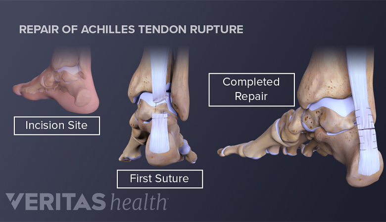 Illustration showing repair of achilles tendon rupture steps.