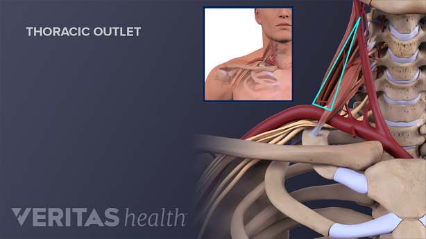 Medical illustration showing Thorasic outlet