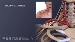thoracic outlet syndrome pain pattern