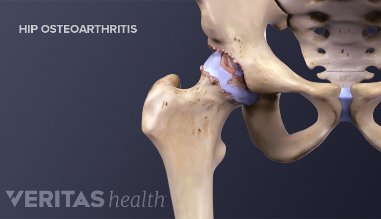 Illustration showing hip joint osteoarthritis.