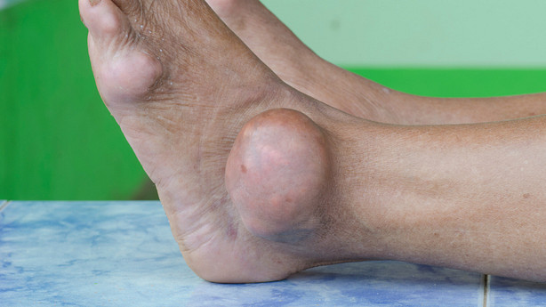 A swollen ankle as a result of gout.