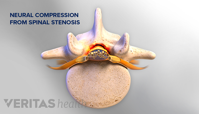 Illustration showing lumbar vertebra with spinal stenosis.