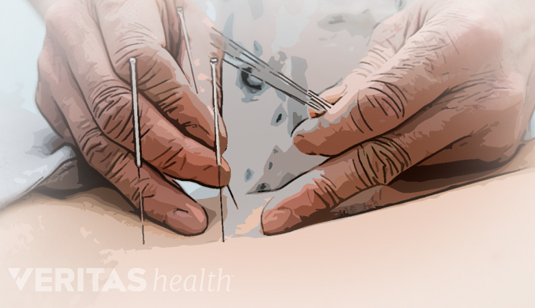 An illustration showing a therapist performing acupuncture with needles