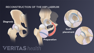Hip labrum reconstruction process: diagnosis, graft preparation, and graft placement.
