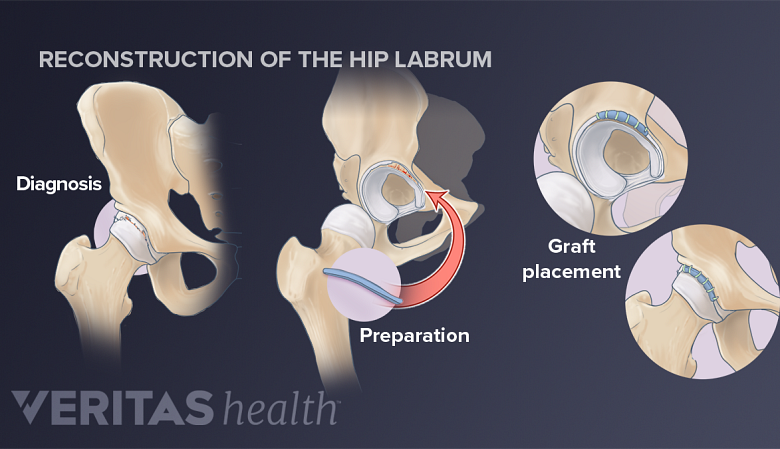 Hip labrum reconstruction process: diagnosis, graft preparation, and graft placement.
