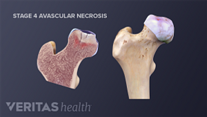 Avascular necrosis is a bone disorder causing decreased blood and nutrient supply and eventual bone collapse in the affected area.