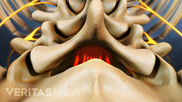 Posterior view of isthmic spondylolisthesis in the lumbar spine.