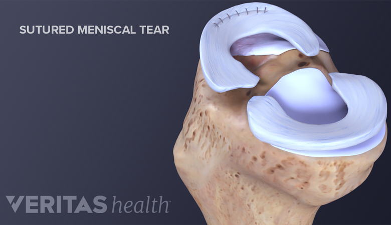 Anatomy of knee joint showing sutured meniscal tear.