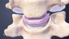 Vista anterior de dos vértebras que muestran el disco entre ellas.