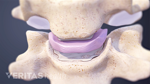Disco cervical entre dos vértebras.