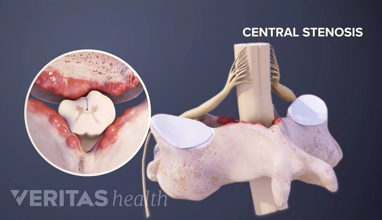 Top down and side 3D illustration of central stenosis.
