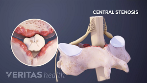 Consumer Health: Treating spinal stenosis - Mayo Clinic News Network