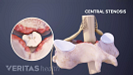 Medical illustration of a vertebrae showing spinal stenosis.