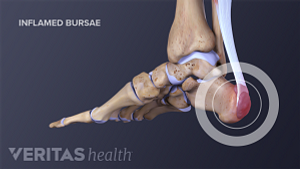 Medical illustration of the Achilles tendon with an inflamed bursae