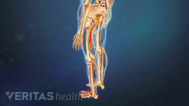 Nerve pain traveling from the pelvis into the leg and foot.