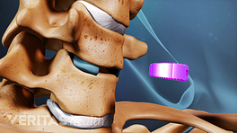 Medical illustration showing a disc being replaced between two vertebrae with an artificial disc