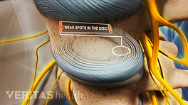 Weak spots in the disc of the lumbar spine.