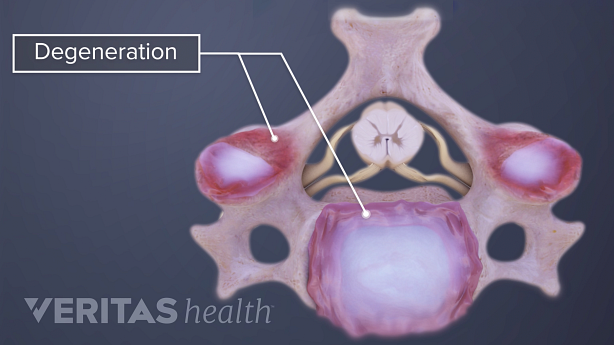 3D image of cervical vertebra.
