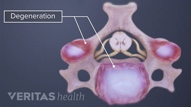 Top down view of a cervical vertebra with degeneration.