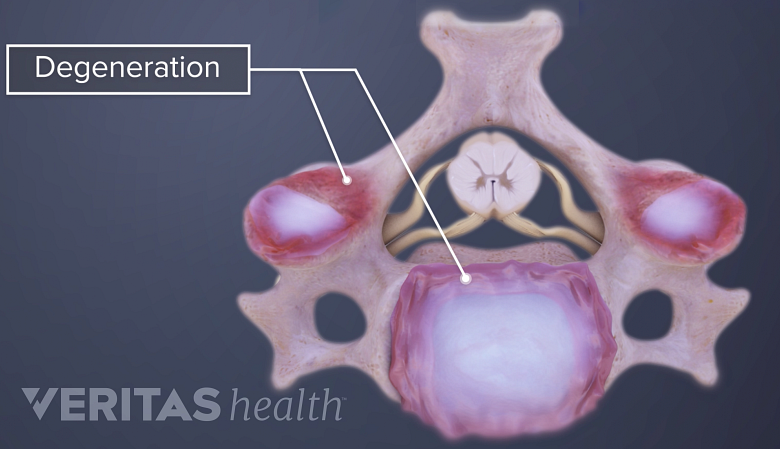 Illustration showing degeneration in the cervical disc.