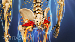 Posterior view of the pelvis showing piriformis syndrome.