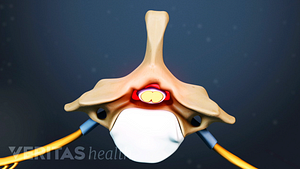 Superior view of narrow spinal canal space.