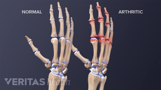 Comparing anatomy of hand with arthritis and without
