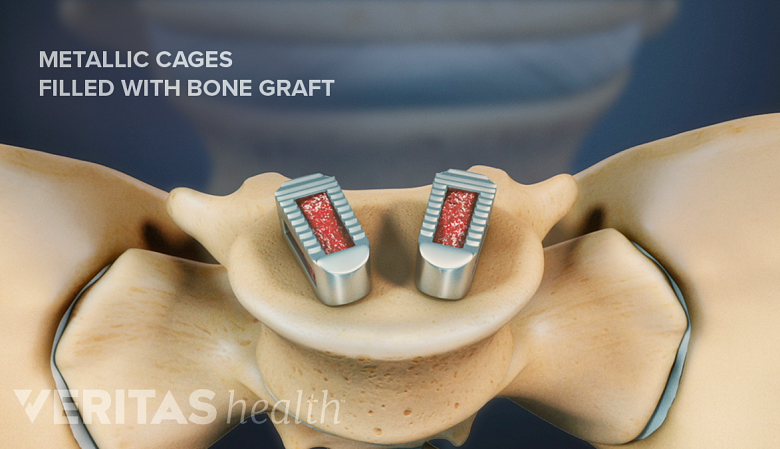 Bone graft is placed inside the cage placed inside the disc space of the lumbar spine.