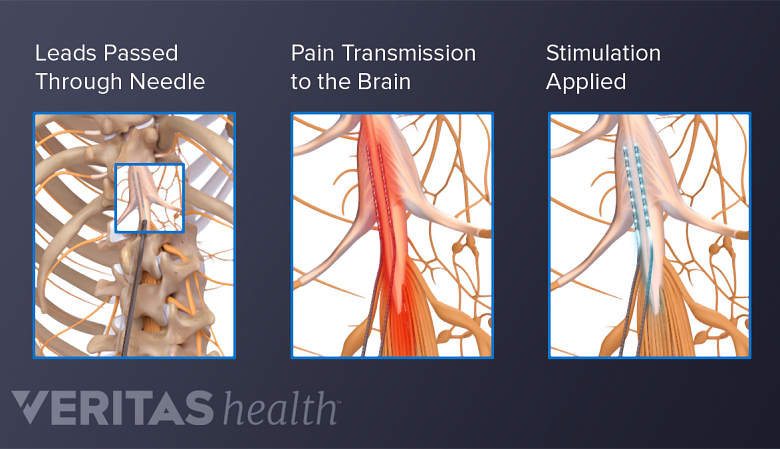 The insertion of spinal cord stimulator leads through a needle into the epidural space, transmission of pain signals in the spine, and application of neurostimulation.