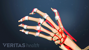 Illustration of arthritic hand bones