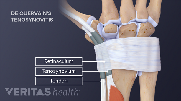 Dorsal view of the hand including retinaculum, tenosynovium and thumb which causes De Quervain’s Tenosynovitis.