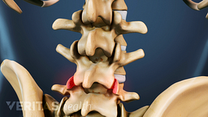 Posterior view of the spine with facet joints highlighted