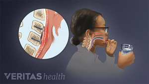 Profile view of a woman swallowing a pill with an inset of the esophagus highlighted and enlarged showing the causes of dysphagia