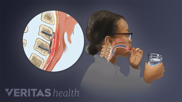 Illustration showing difficulty in swallowing.