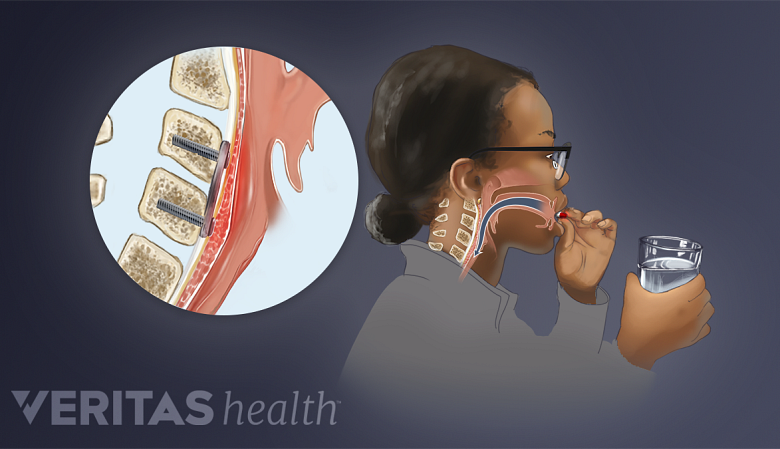Illustration showing a woman swallowing a pill and a inset showing fusion in cervical spine.