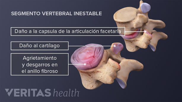 Los componentes de una vértebra inestable.