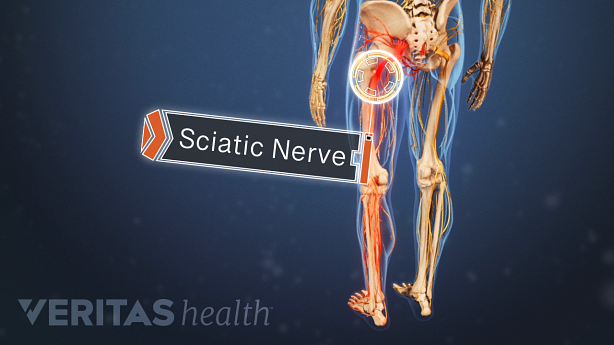 Posterior view of the lower body showing sciatica pain in the legs.